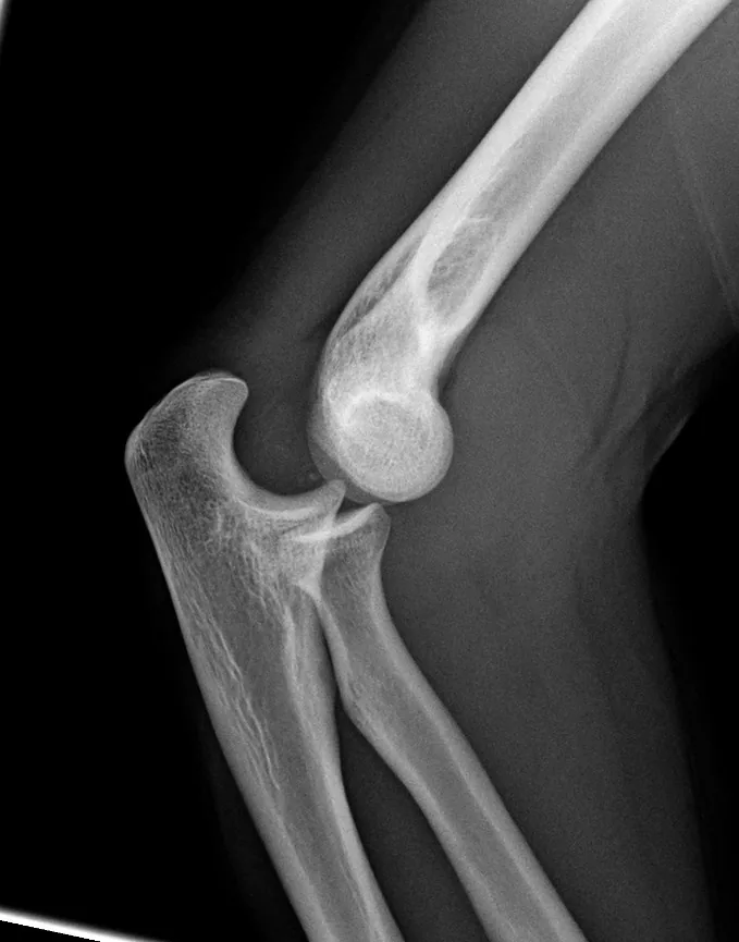 Upper limb radiograph for self-assessment