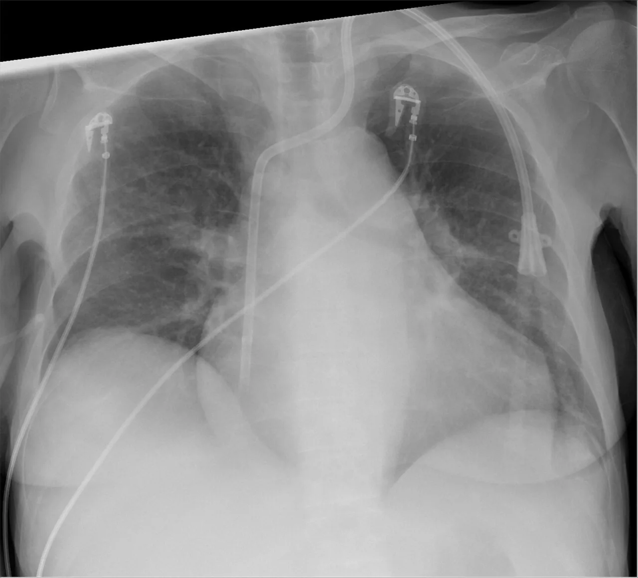 Lines & tubes radiograph for self-assessment