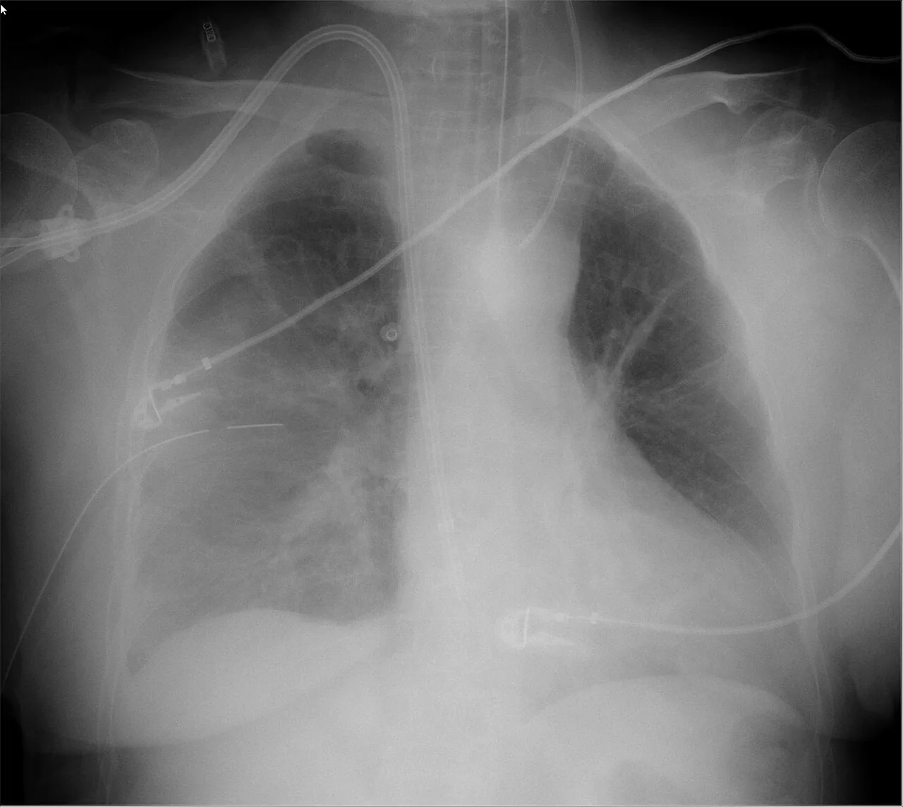 Lines & tubes radiograph for self-assessment