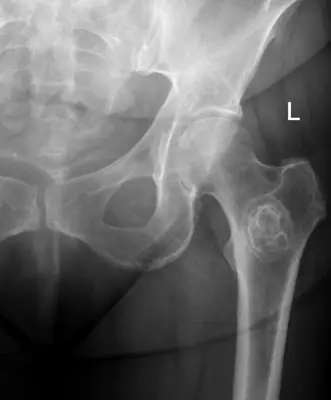 Radiograph from the case bank: Bone metastases