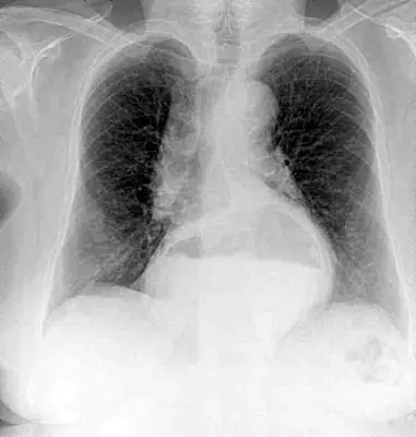 Radiograph from the case bank: Diaphragmatic hernia