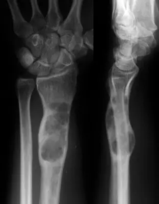 Radiograph from the case bank: Enchondroma