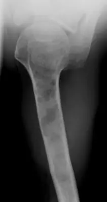 Radiograph from the case bank: Enchondroma