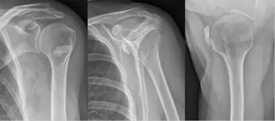 Radiograph from the case bank: Calcific tendinitis