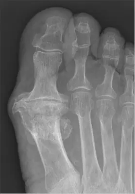 Radiograph from the case bank: Hallux rigidus (first MTP osteoarthritis)