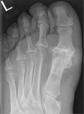 Radiograph from the case bank: Hallux rigidus (first MTP osteoarthritis)
