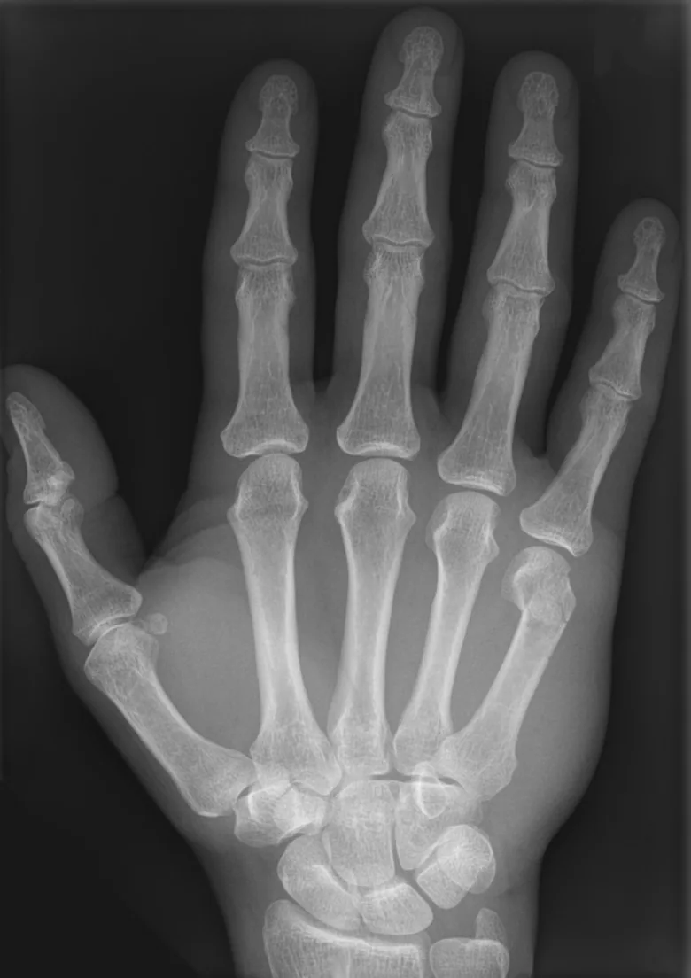 Upper limb radiograph for self-assessment