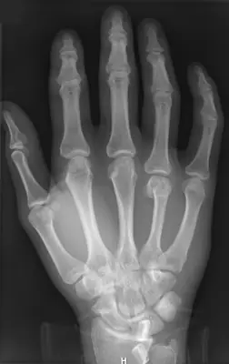 Radiograph from the case bank: Metacarpal fracture