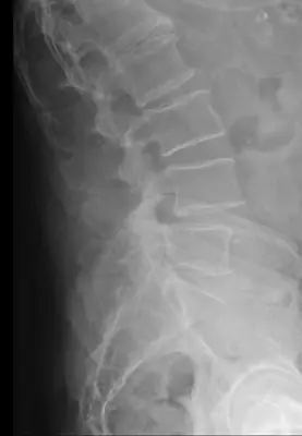 Radiograph from the case bank: Spondylolisthesis