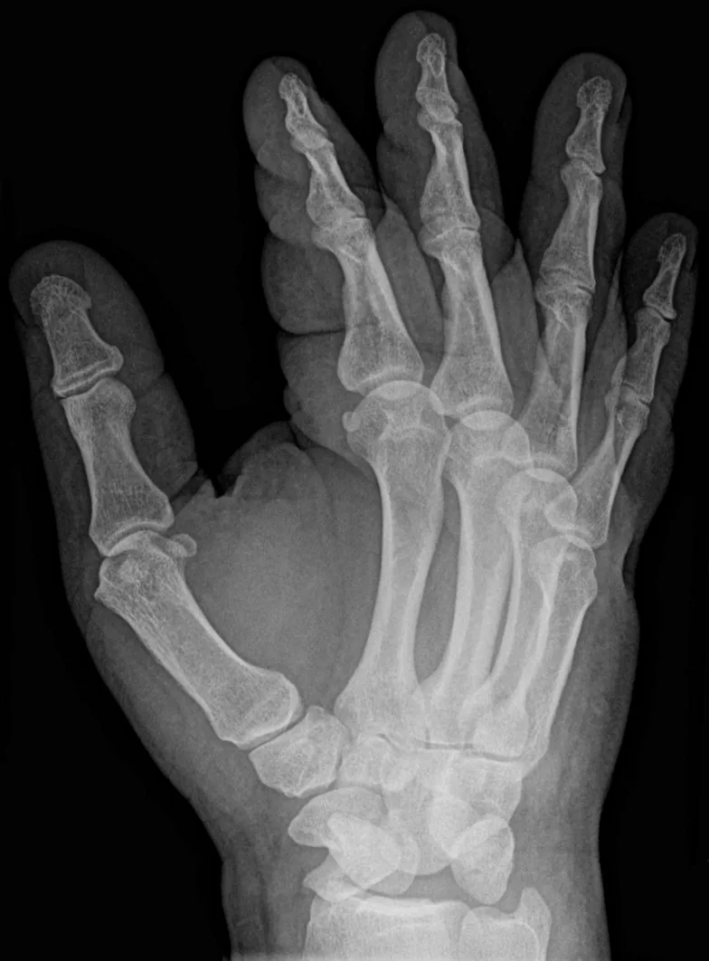 Upper limb radiograph for self-assessment