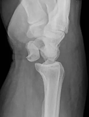 Radiograph from the case bank: Carpal or carpometacarpal dislocation