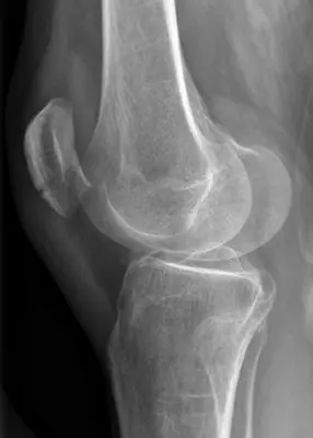 Radiograph from the case bank: Patellar fracture