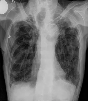Radiograph from the case bank: Pulmonary tuberculosis