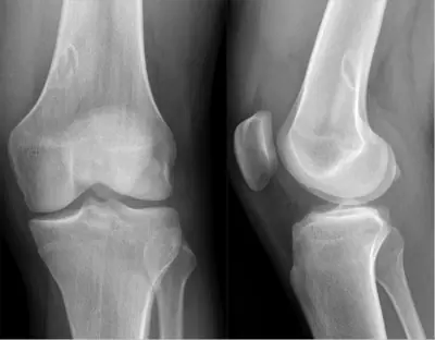 Radiograph from the case bank: Non-ossifying fibroma