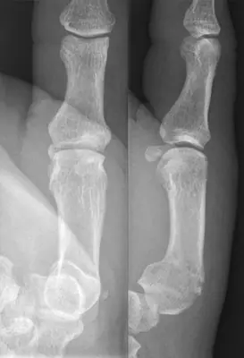Radiograph from the case bank: Metacarpal fracture