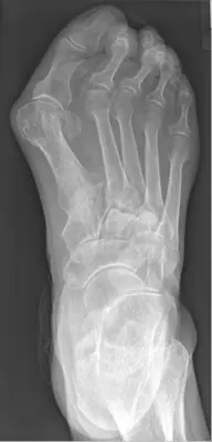 Radiograph from the case bank: Hallux valgus (bunion)