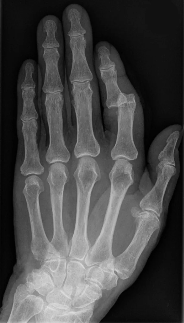 Upper limb radiograph for self-assessment