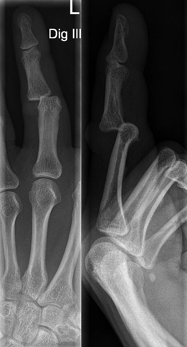 Upper limb radiograph for self-assessment