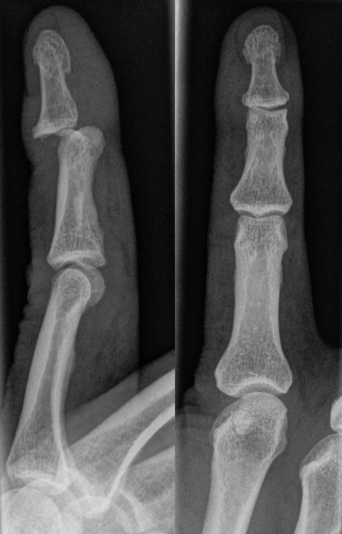 Upper limb radiograph for self-assessment