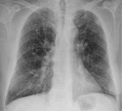 Radiograph from the case bank: Emphysema / COPD (hyperinflation)