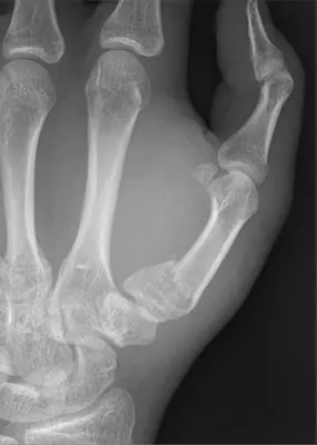 Radiograph from the case bank: Metacarpal fracture