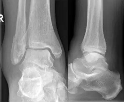 Radiograph from the case bank: Ankle fracture (lateral malleolus)