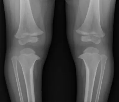 Radiograph from the case bank: Blount disease (tibia vara)