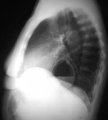 Radiograph from the case bank: Hiatus hernia