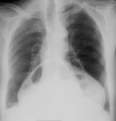 Radiograph from the case bank: Hiatus hernia