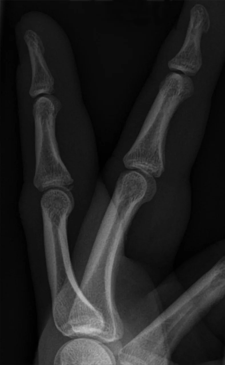 Upper limb radiograph for self-assessment