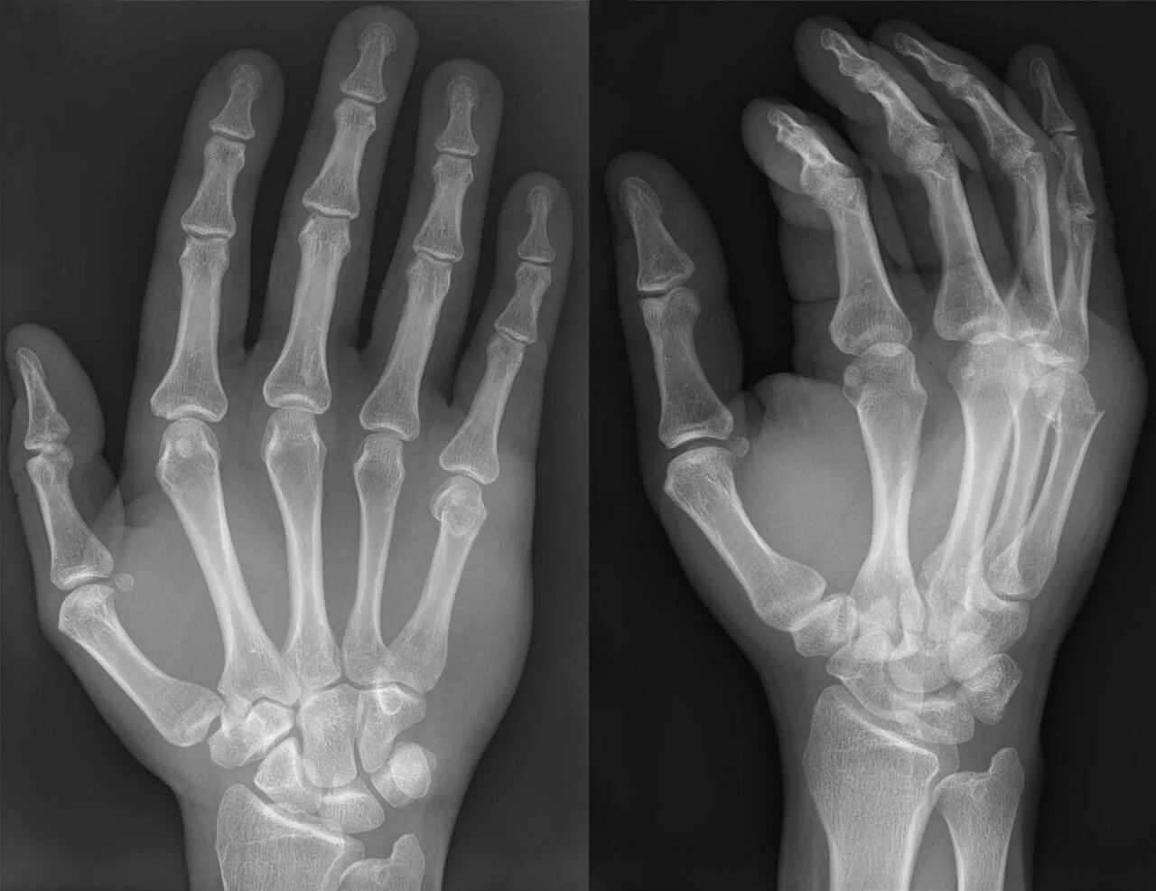 Upper limb radiograph for self-assessment