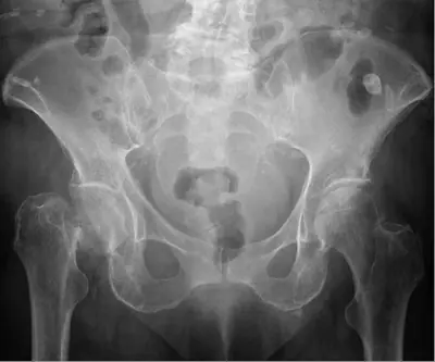 Radiograph from the case bank: Hip (proximal femoral) fracture