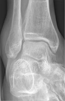 Radiograph from the case bank: Ankle fracture (lateral malleolus)