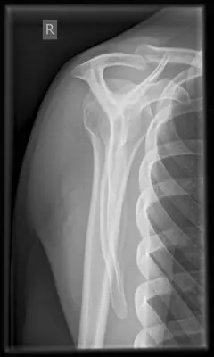 Radiograph from the case bank: Normal shoulder radiograph