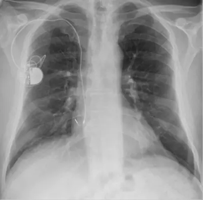 Radiograph from the case bank: Cardiac pacemaker