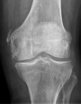 Radiograph from the case bank: Pellegrini–Stieda lesion