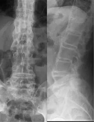 Radiograph from the case bank: Ankylosing spondylitis