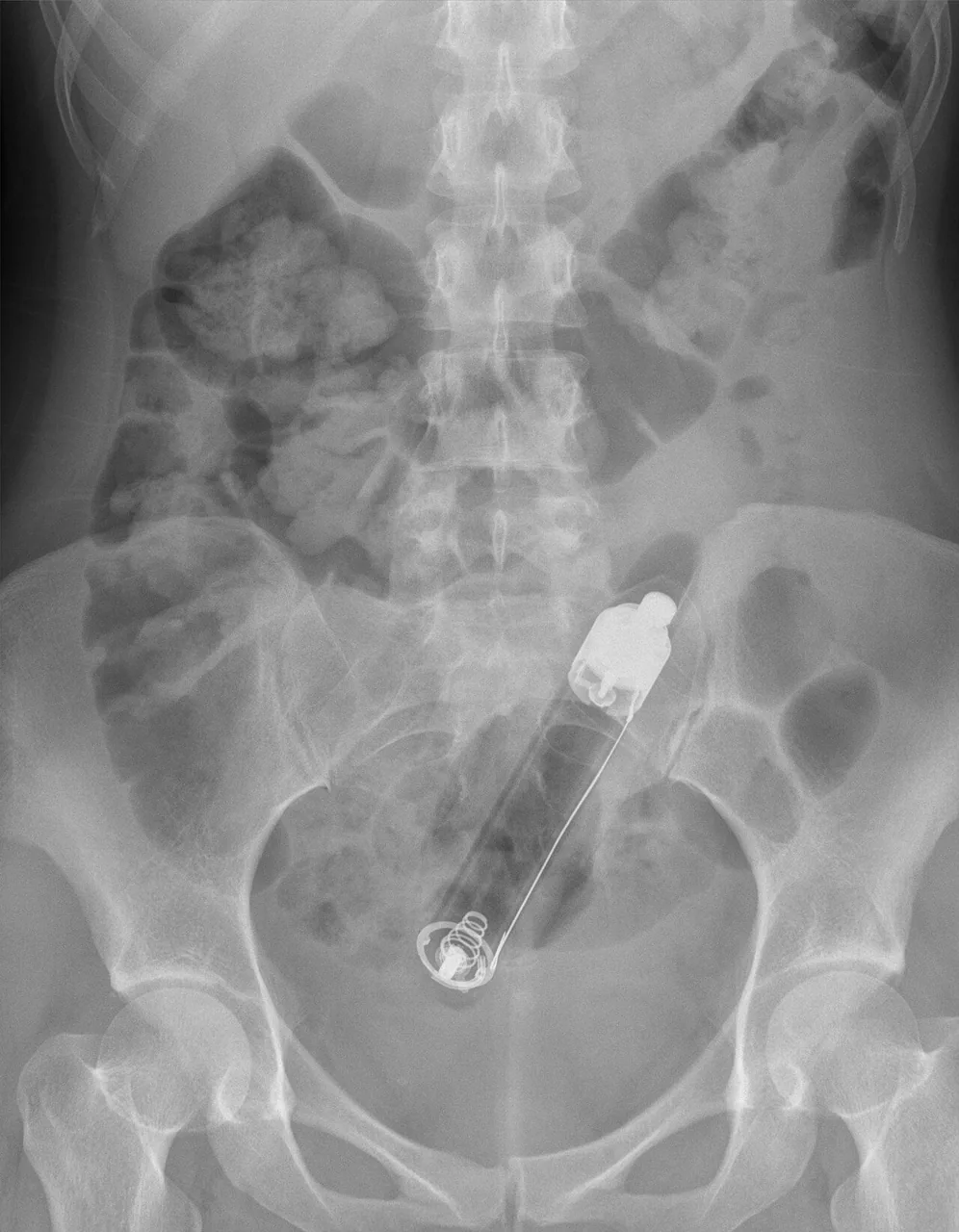 Abdomen radiograph for self-assessment