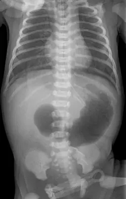 Radiograph from the case bank: Double bubble sign (duodenal atresia)