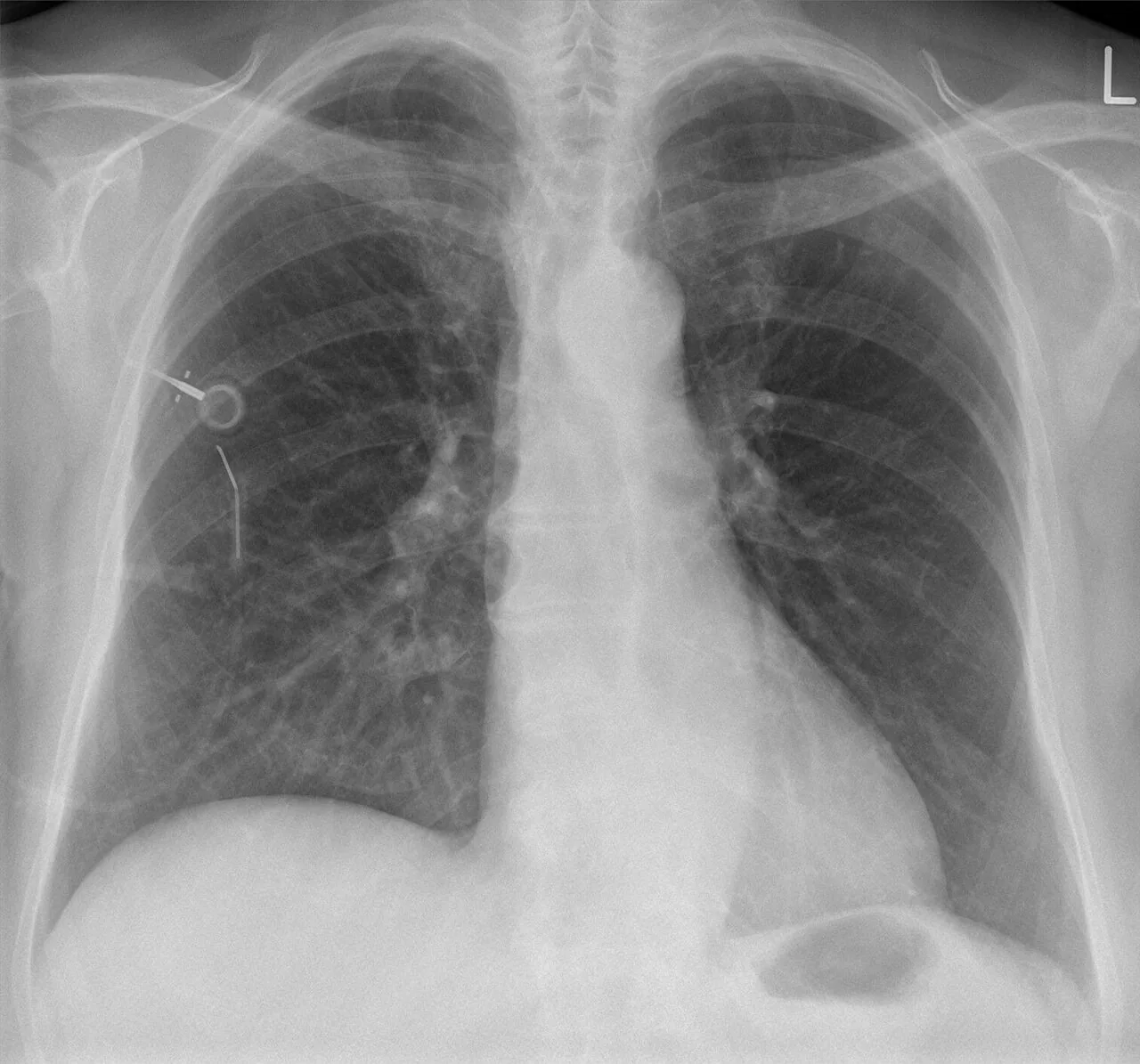 Lines & tubes radiograph for self-assessment