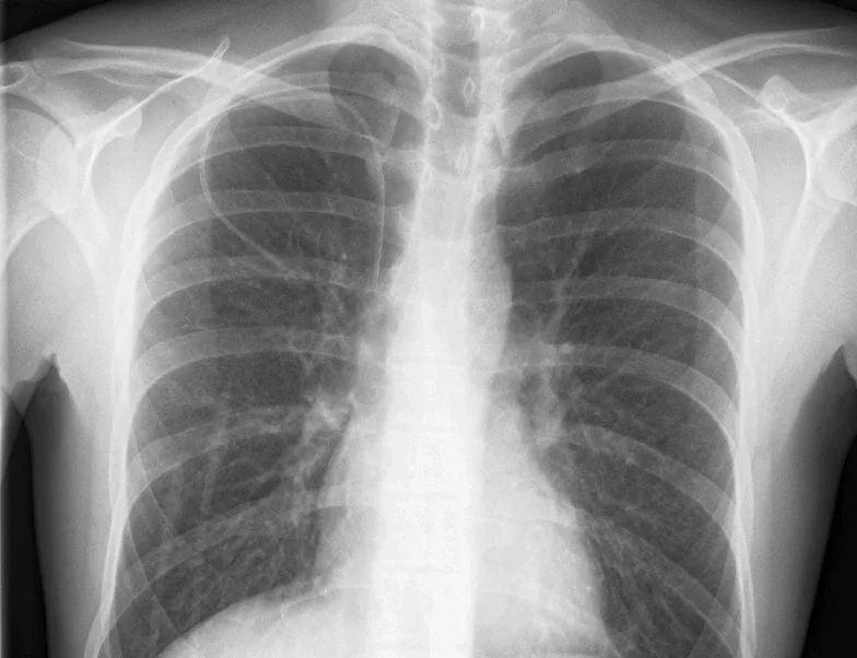 Lines & tubes radiograph for self-assessment