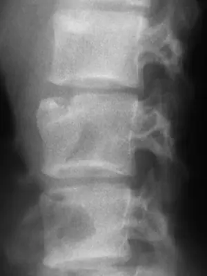 Radiograph from the case bank: Osteomyelitis