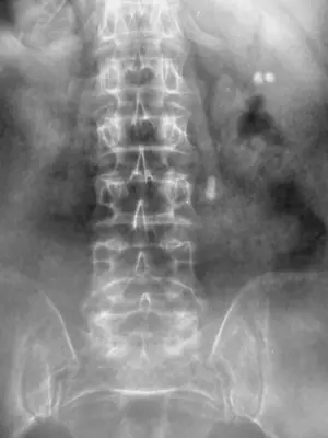 Radiograph from the case bank: Urinary tract calculi (kidney or ureteric stones)