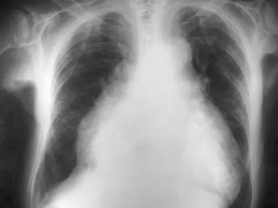 Radiograph from the case bank: Cardiomegaly