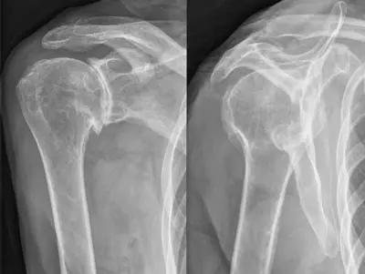 Radiograph from the case bank: Osteoarthritis