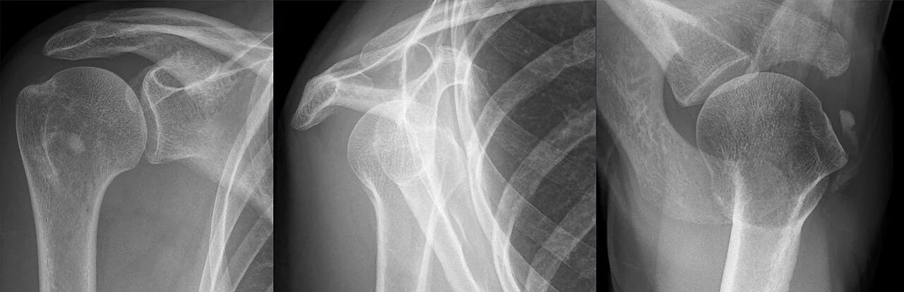 Upper limb radiograph for self-assessment