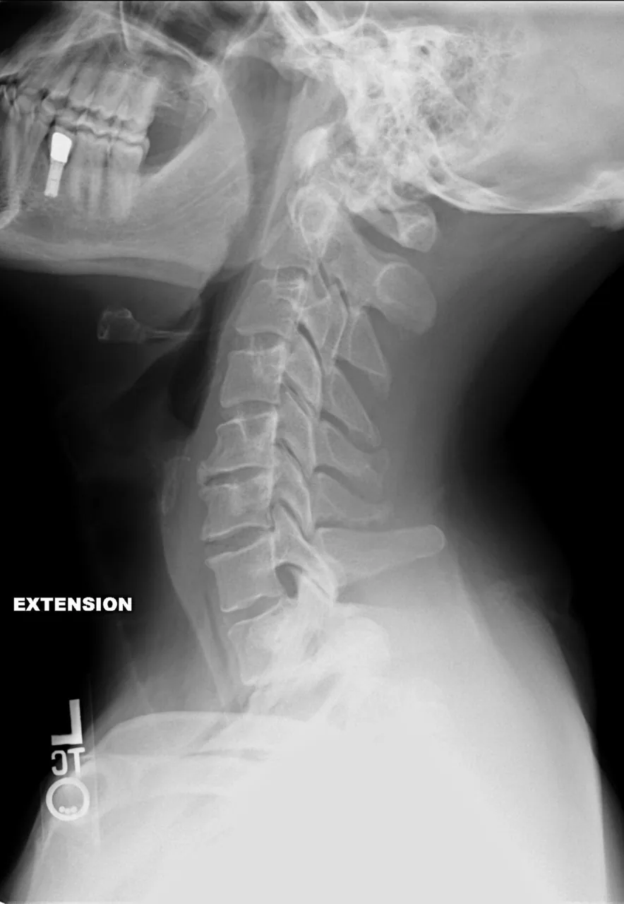 Spine radiograph for self-assessment