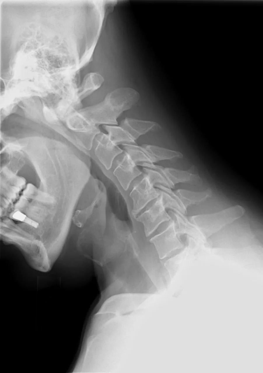 Spine radiograph for self-assessment