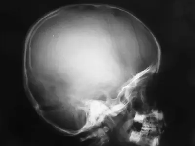 Radiograph from the case bank: Skull fracture