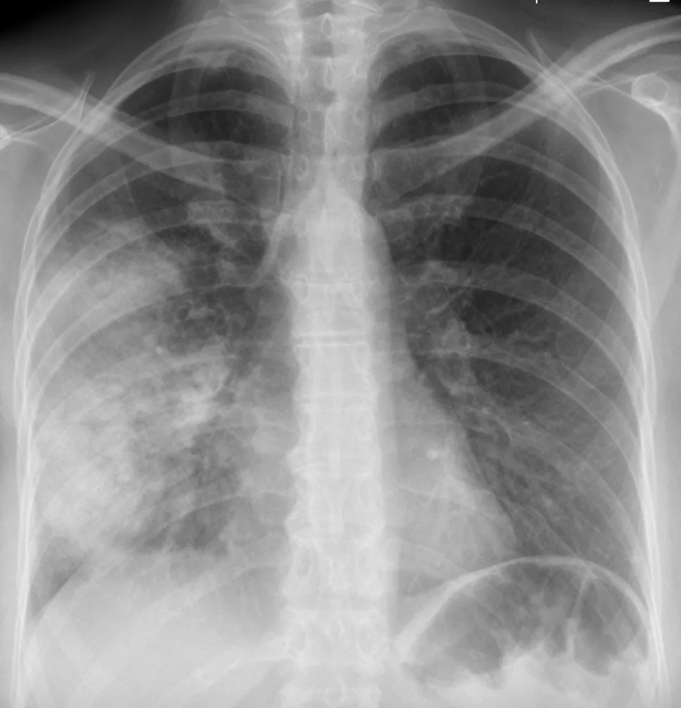 Chest radiograph for self-assessment